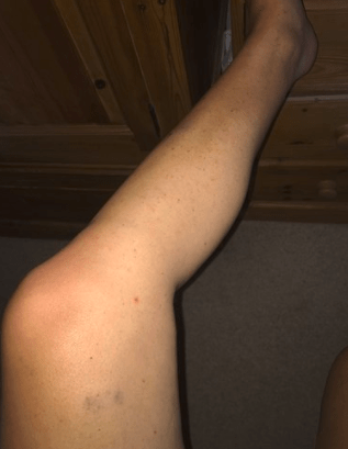 leukaemia rash on legs