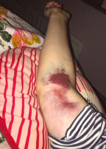 blood cancer symptoms shown as bruises on an arm 