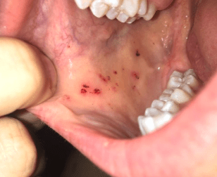 leukaemia rash in mouth