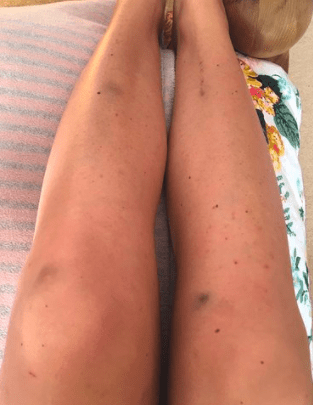 Leukaemia Rash on legs